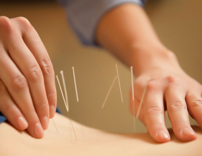 Иглорефлексотерапия - СКК Мрия Резорт & Спа