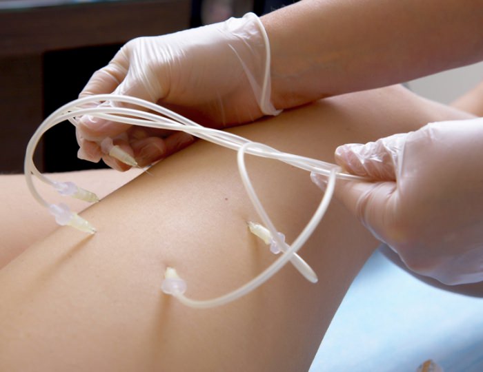 Озонотерапия - Санаторий «Целебный ключ»